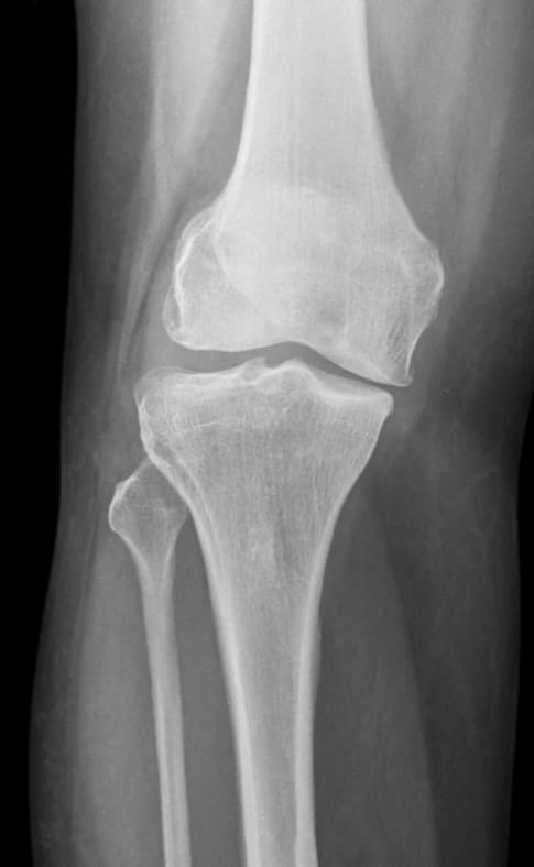 Raio-X do joelho