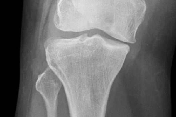 Raio-X do joelho